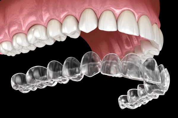 Invisalign